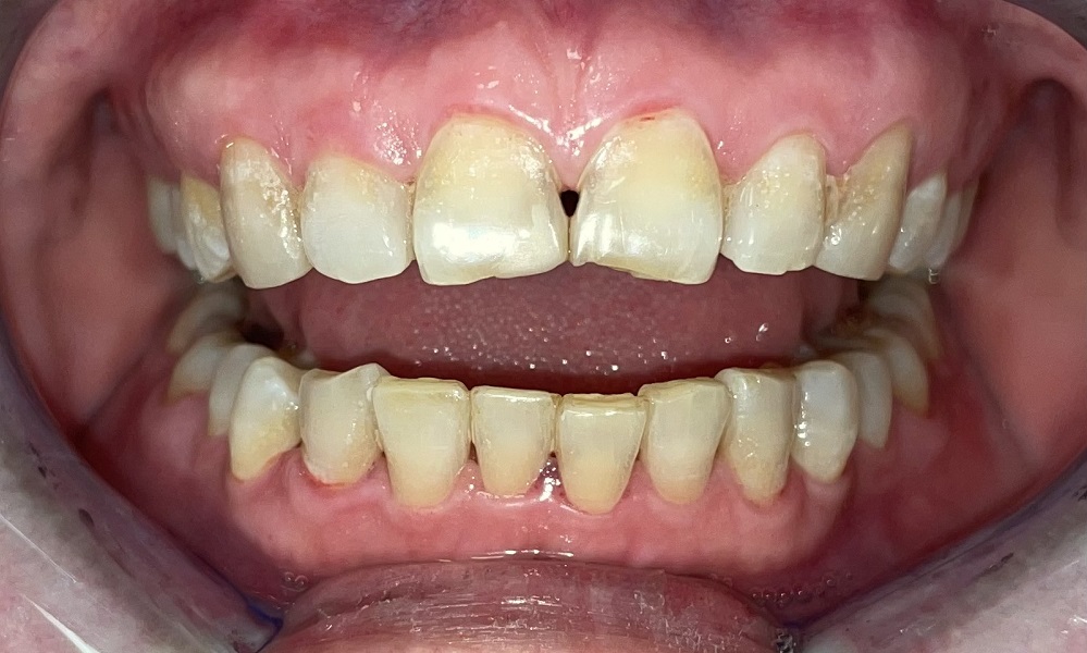 fogászat száj rehabilitáció